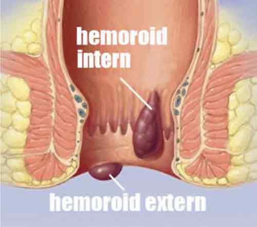 Foto hemoroizi interni si externi